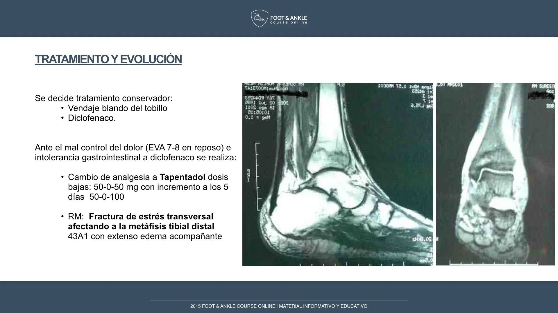 Fractura de estrés en metafisis tibia distal .003