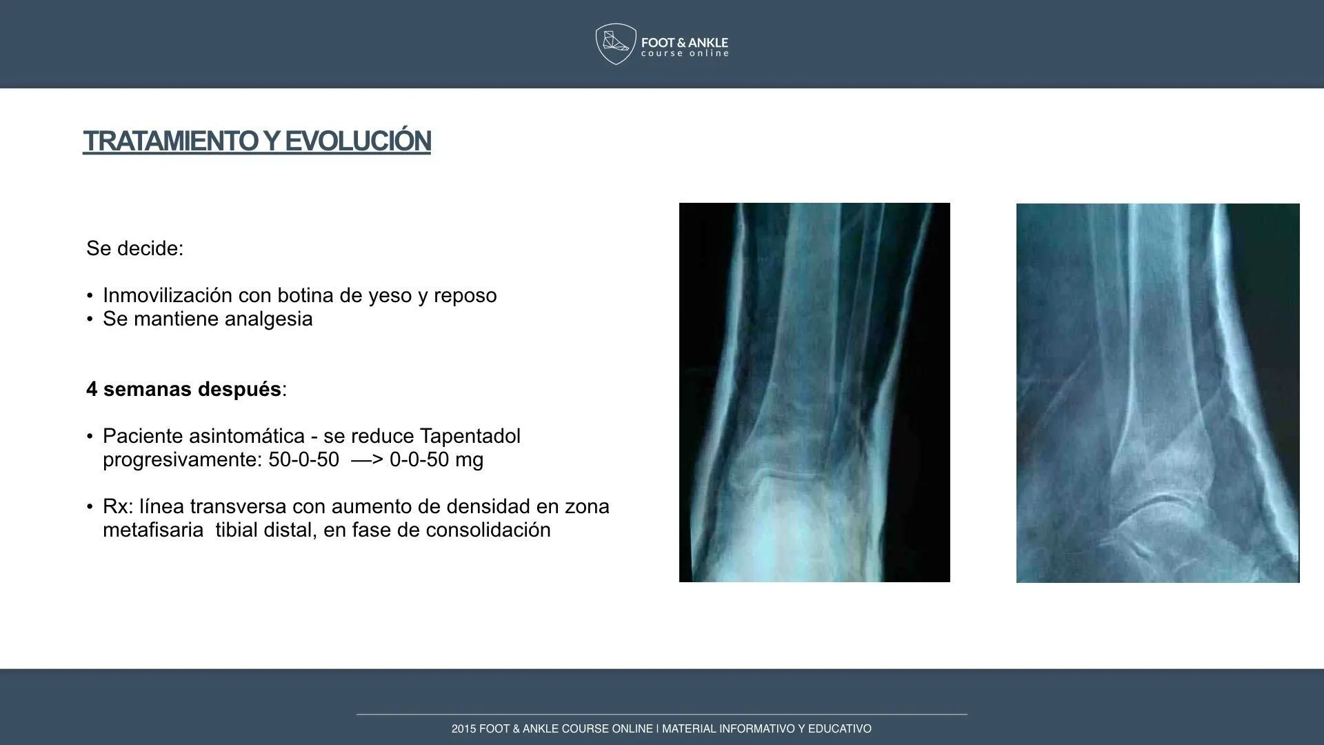 Fractura de estrés en metafisis tibia distal .004