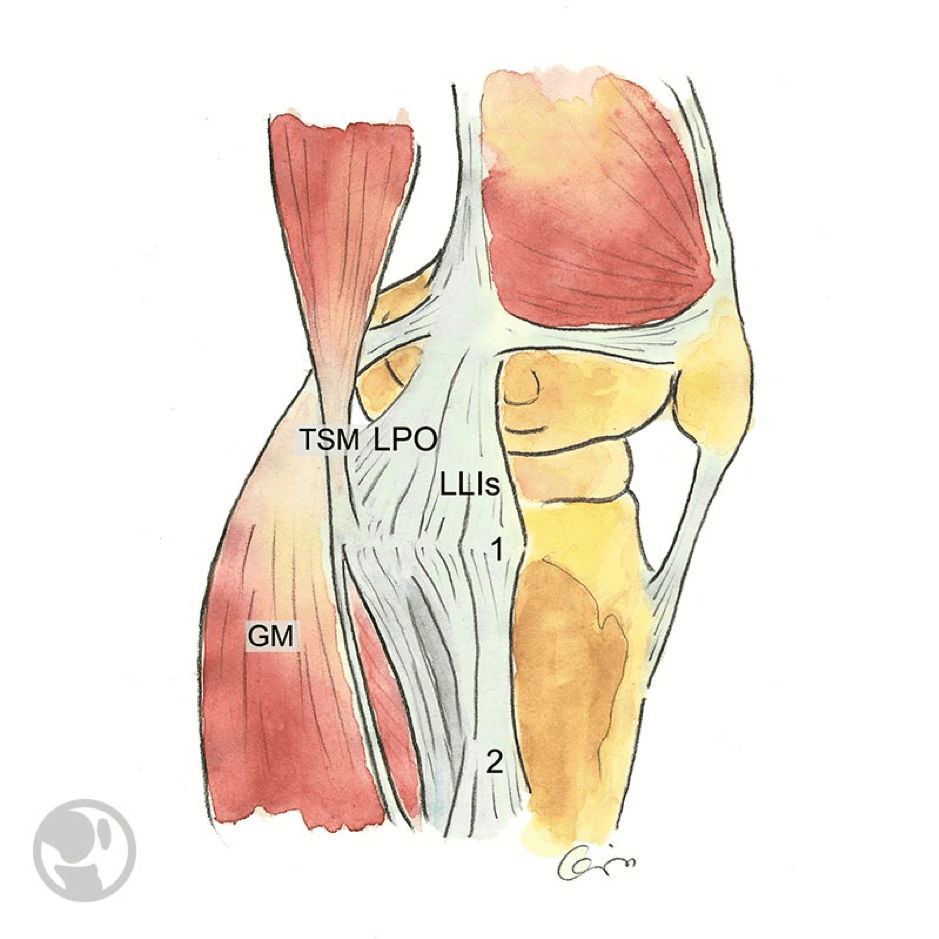 Relaciones anatómicas del ligamento colateral medial o interno superficial (LLIs), y el ligamento posterior oblicuo (LPO). Inserción tibial proximal del LLIs (1) e inserción tibial distal del LLIs (2). Tendón del semimembranoso (TSM). Gemelo medial (GM).