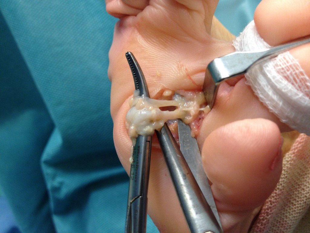 Plantar