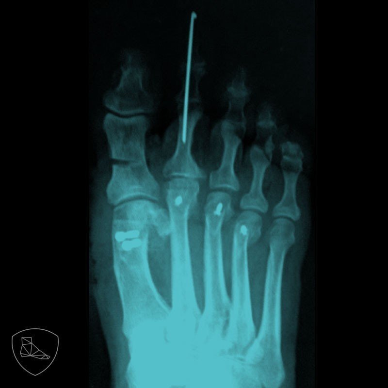 Fig. 20a. Artroplastia IFP fijada temporalmente con aguja de Kw.