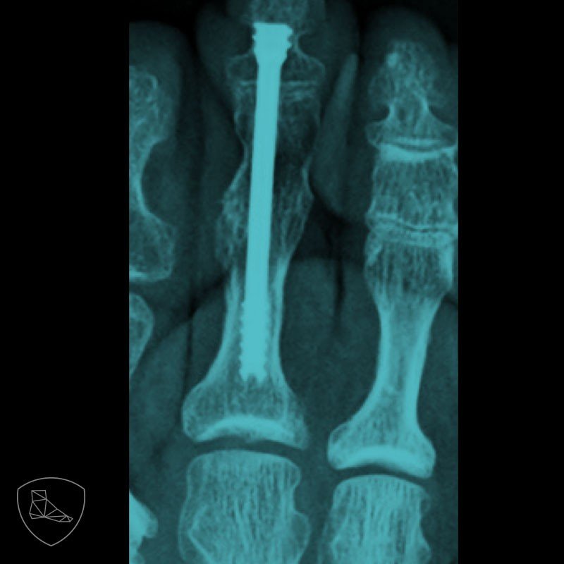 Fig. 20b. Artrodesis IFP sintetizada con tornillo endomedular.