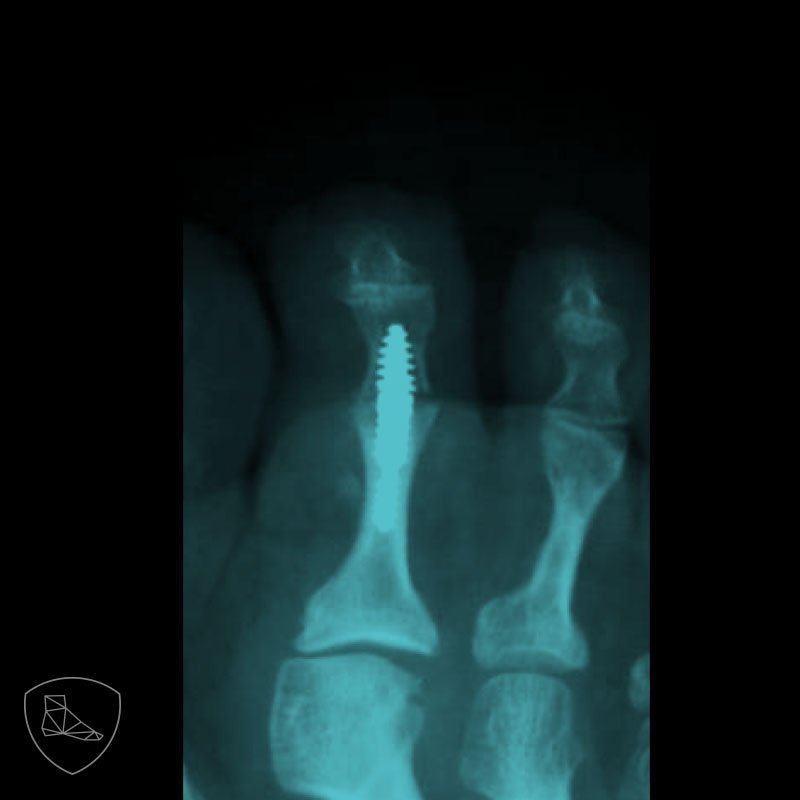 Fig. 20c. Artroplastia IFP mediante sistema endomedular de posición fija.