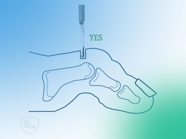 Descubre la Técnica de Cirugía Percutánea del pie. (I)