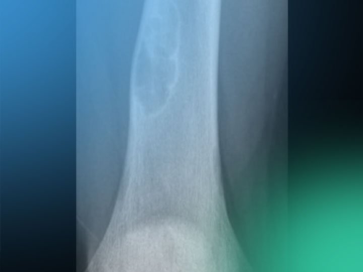 ¿Conoces las lesiones pseudotumorales de la rodilla?