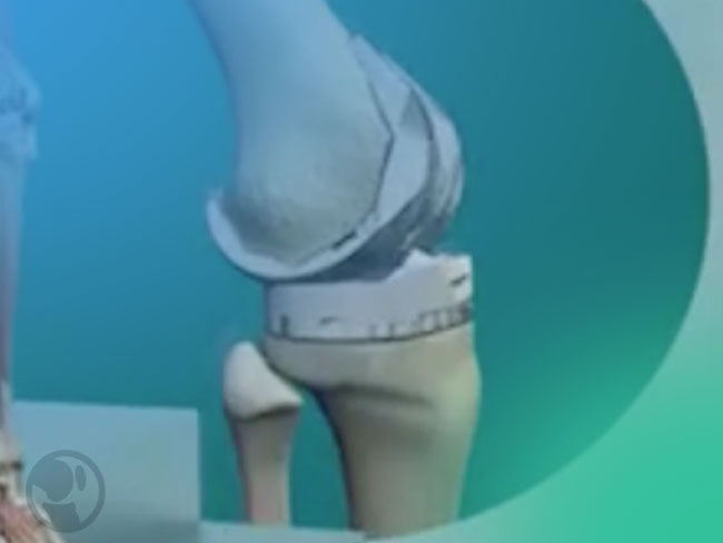 Estado actual de la cirugía de revisión de prótesis total de rodilla.