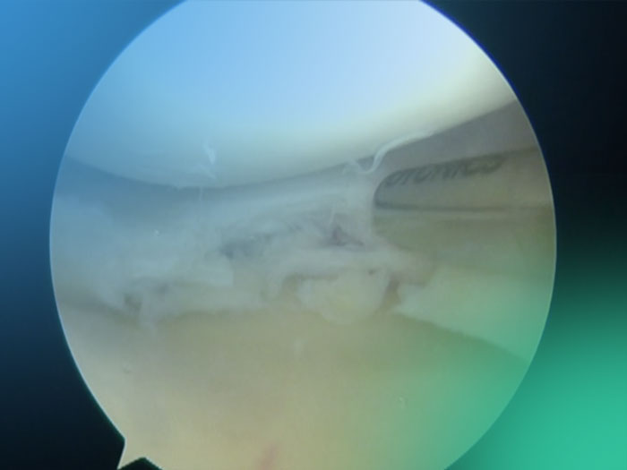 Técnica artroscópica; meniscectomía parcial. (Video).