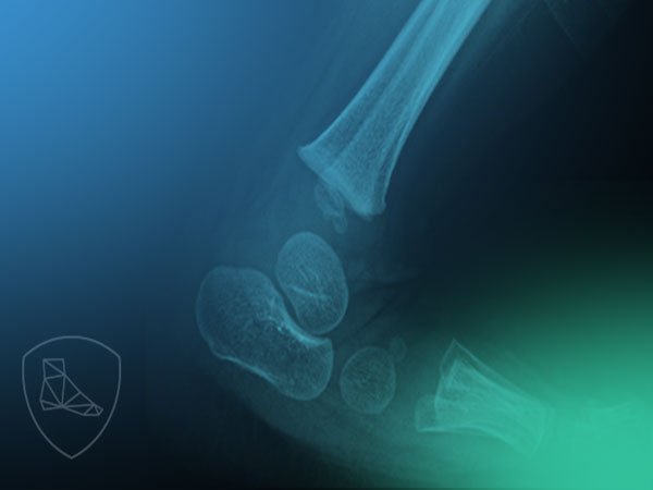 Radiología del pie infantil.
