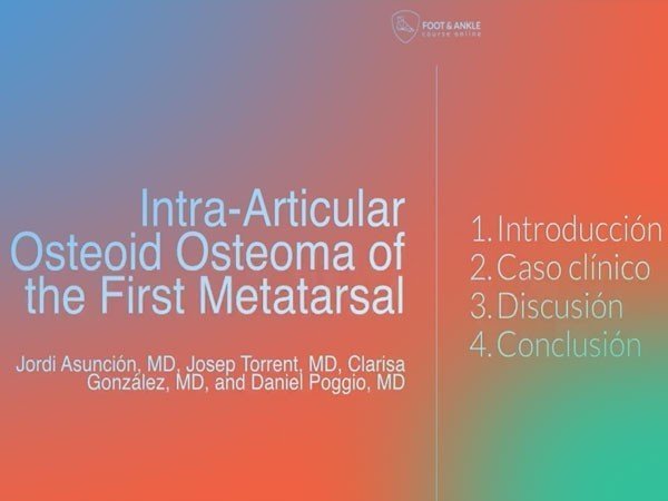 Actualización; Intra-Articular osteoma osteoide (Video).