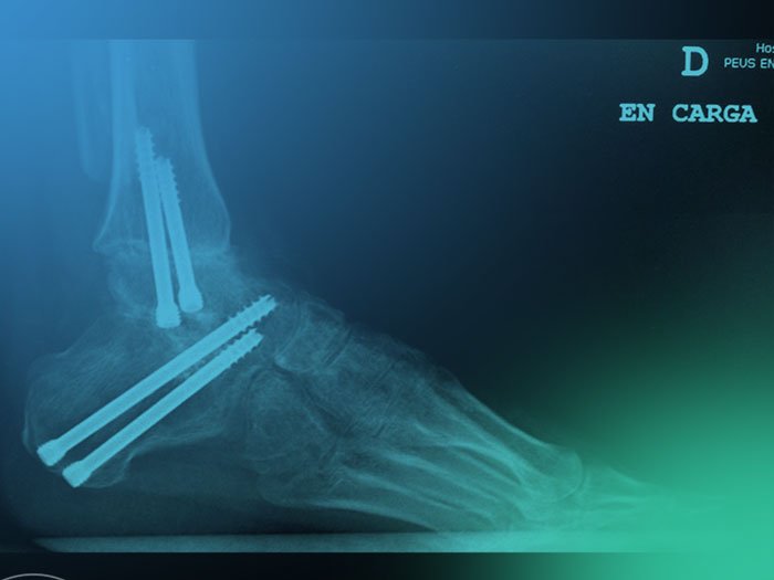 ¿Cuál es el objetivo al realizar una artrodesis de tobillo? Planificación preoperatoria