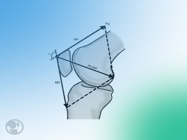 Diagnóstico y tratamientos de la rotura del tendón rotuliano y cuadricipital