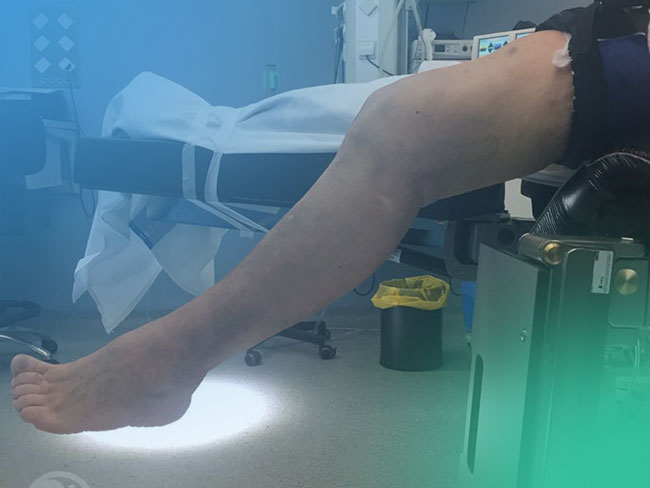 Artofibrosis tras una artroplastia total de rodilla