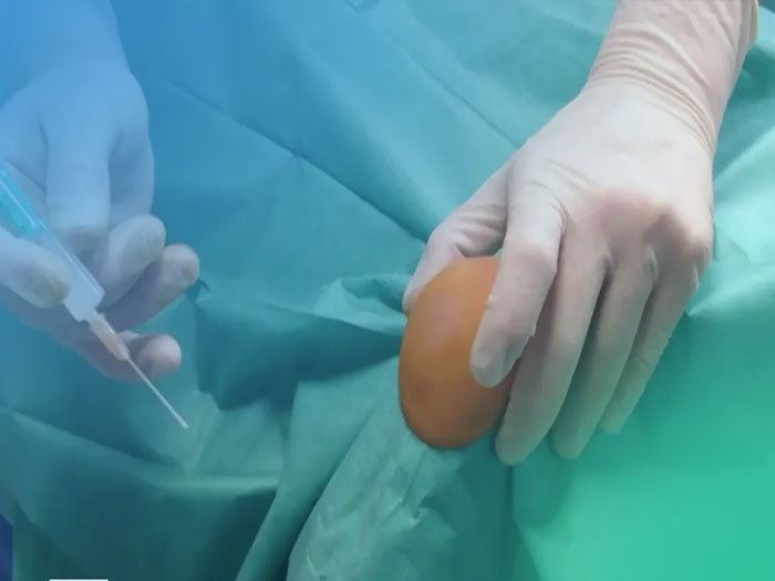 Infiltración fascia plantar. (Video)