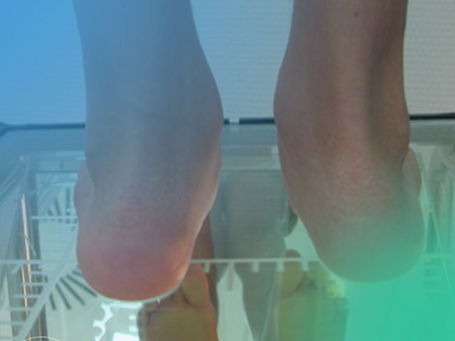 ¿Qué sabes acerca de la clasificación y la anatomía patológica del pie plano?