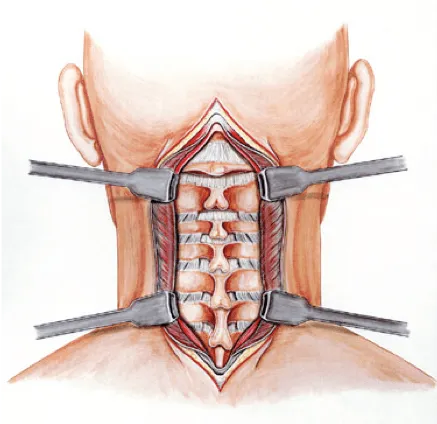 Abordaje cervical posterior.