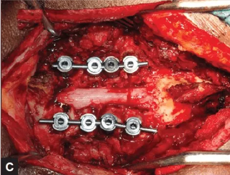 Abordaje cervical posterior. Instrumentación y laminectomía descompresiva.