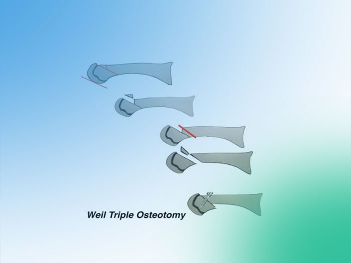 Paso a paso de la Osteotomía de Weil en las metatarsalgias del tercer Rocker (propulsivas).