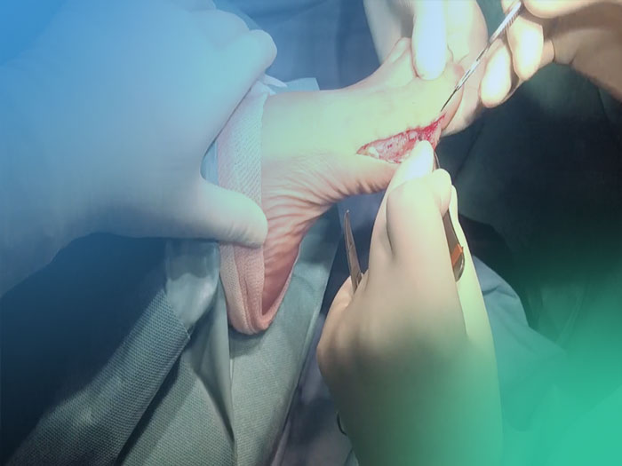 Conoce en este video los orígenes y desarrollo de la artroscopia en el Pie y Tobillo