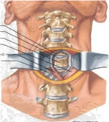 Abordaje cervical anterior.