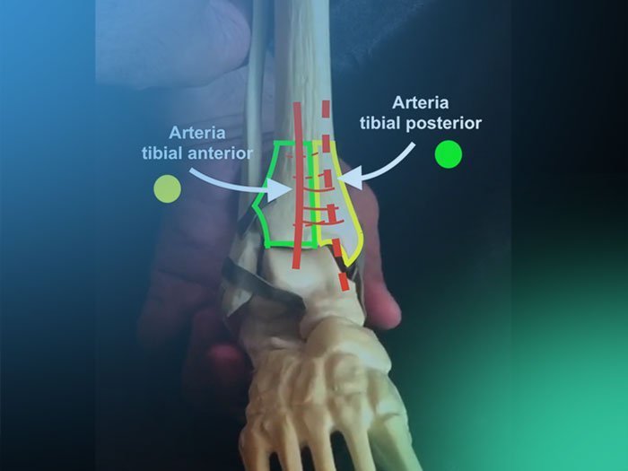 Fracturas del pilón tibial
