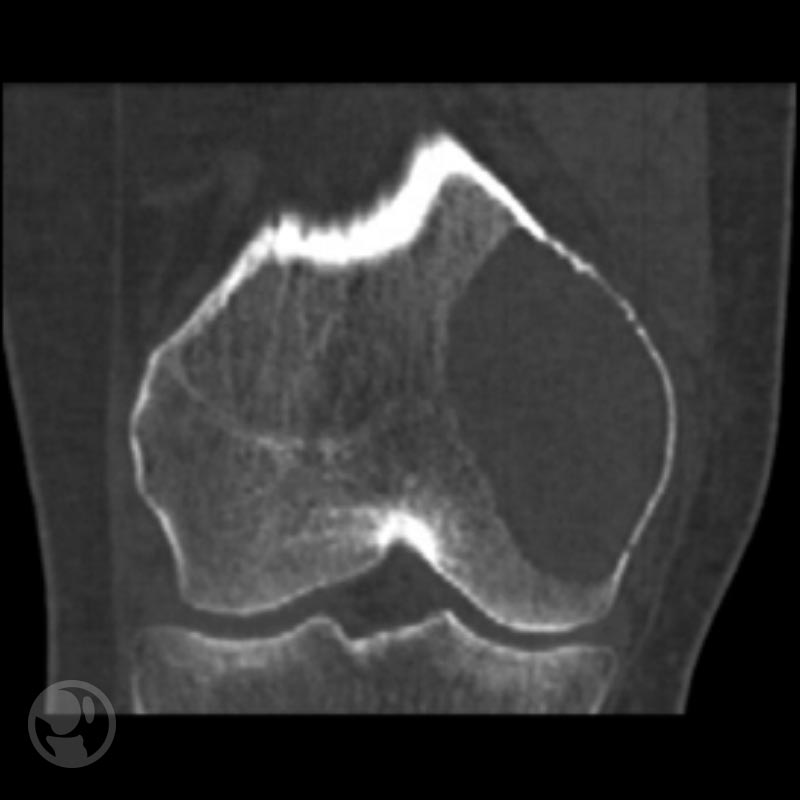 Imagen de TC que muestra una lesión lítica en el cóndilo medial de la rodilla.