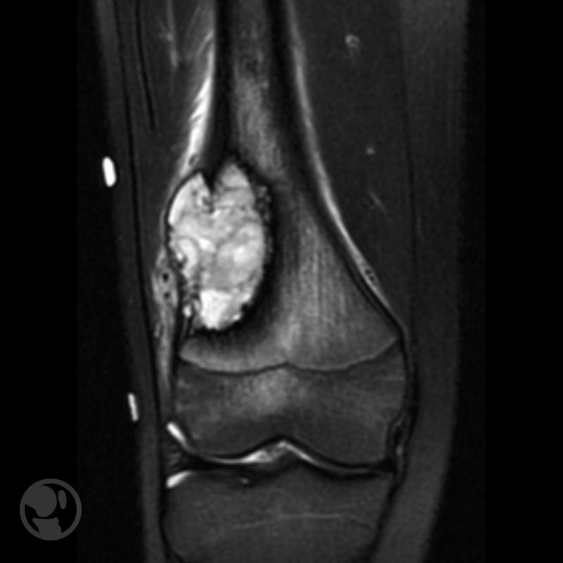 Imagen de RM que permite delimita la lesión, la invasión medular existente, y la posible afectación de partes blandas por parte de la tumoración.