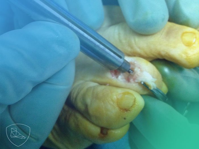 Guía práctica para el Tratamiento de la patología de los dedos menores