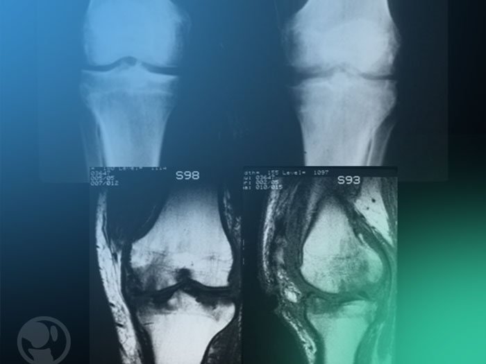 Descubre el diagnóstico de la artritis séptica y conducta a seguir