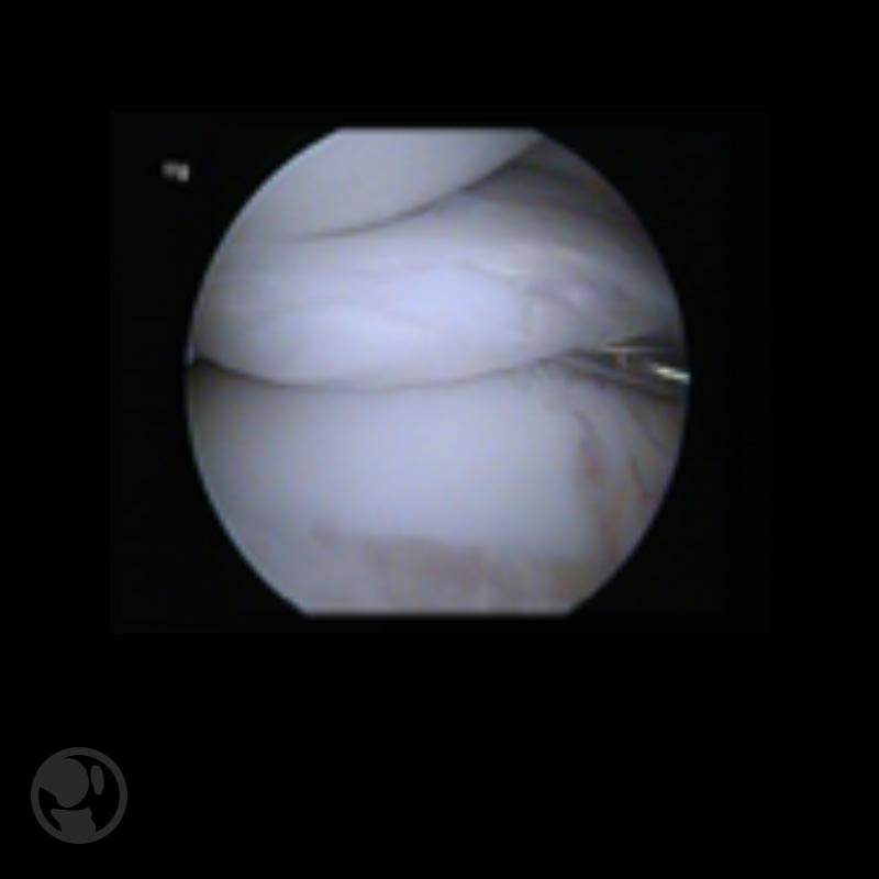 Ruptura del cuerno posterior del menisco medial