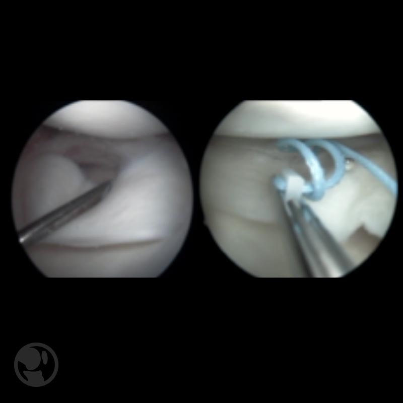 Reparación de lesión longitudinal del cuerno posterior del menisco medial.