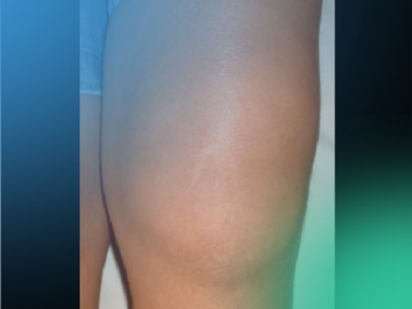 Descubre las lesiones pseudotumorales de la rodilla