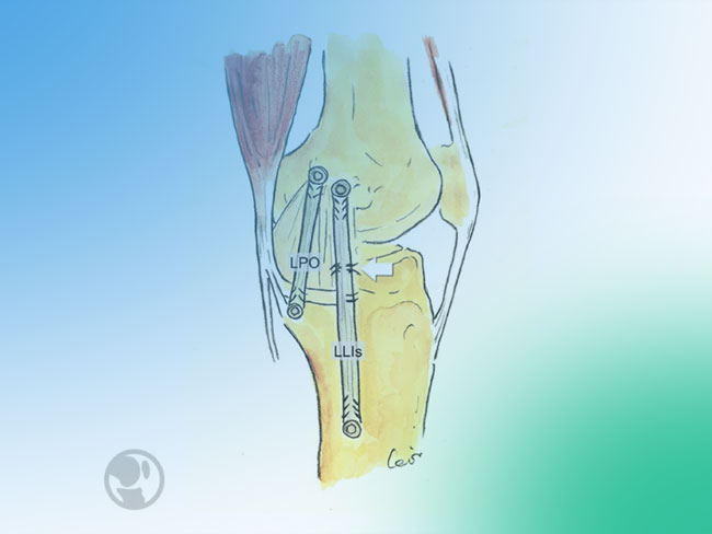 ¿Cómo es el tratamiento según el tipo de lesión ligamentosa medial de la rodilla?