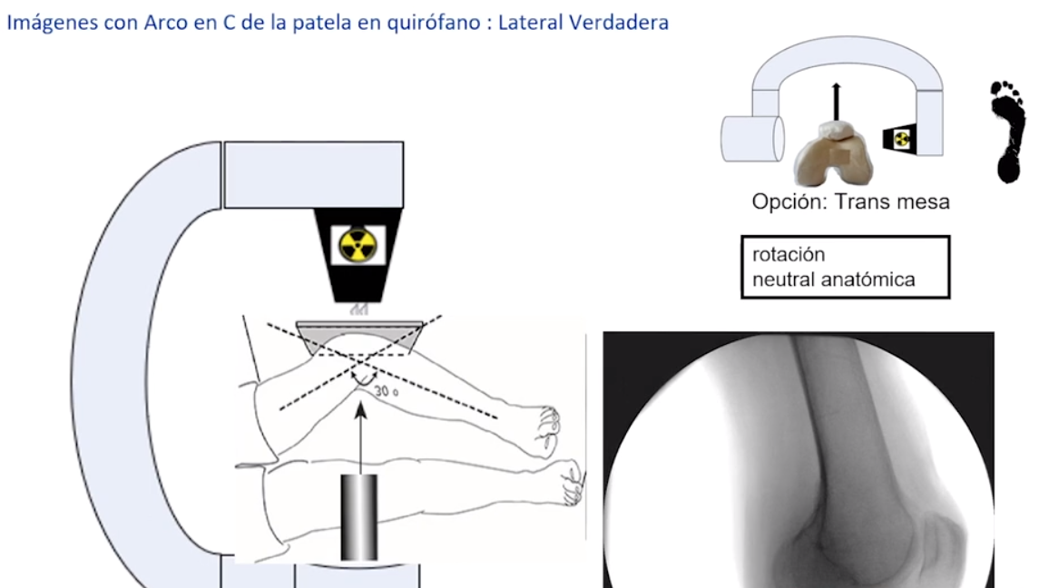 Imágenes Y Referencias Radiológicas Transoperatoria En Cirugía De Patela Awaredoctor