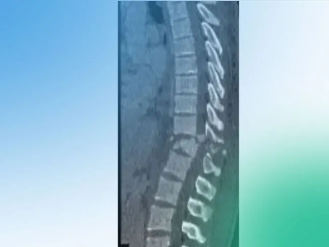 Lesion Taraco Lumbar