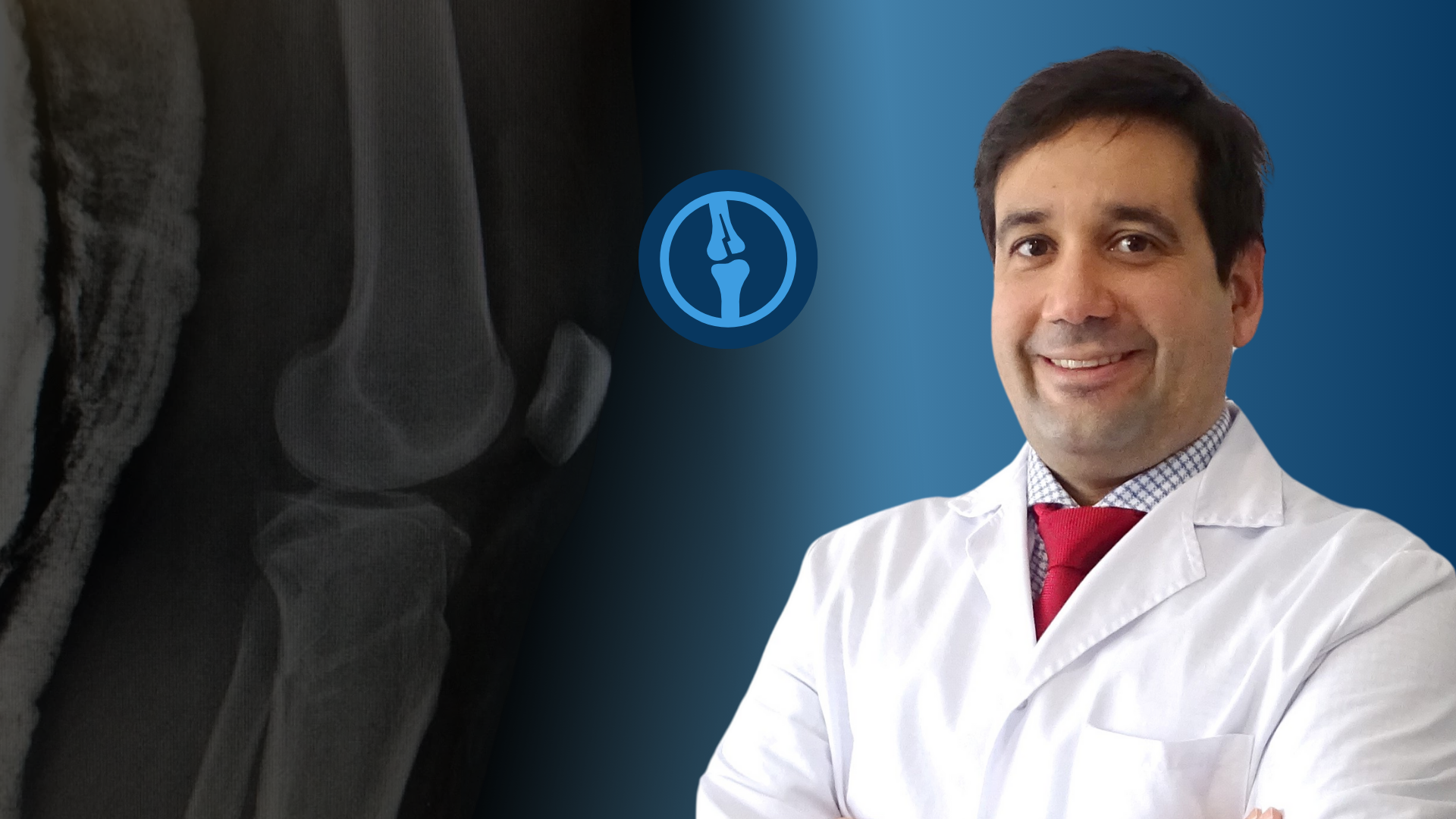 Fracturas de Meseta Tibial: Clasificación, Diagnóstico y Abordaje Clínico Paso a Paso